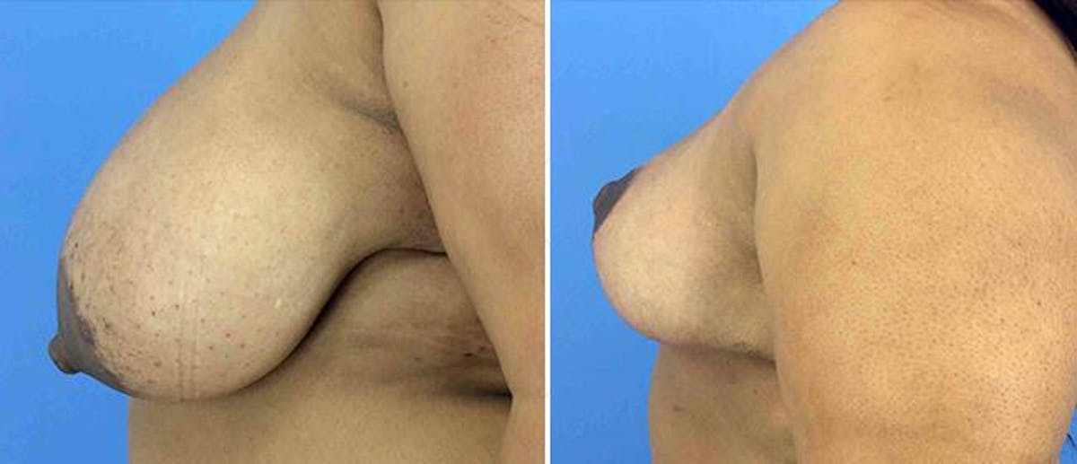 Breast Reduction Before & After Gallery - Patient 38566401 - Image 1