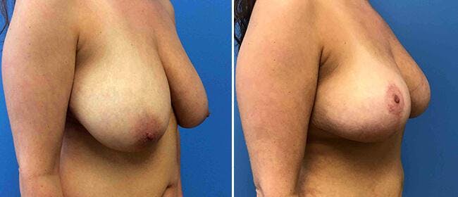 Breast Reduction Before & After Gallery - Patient 38566404 - Image 1