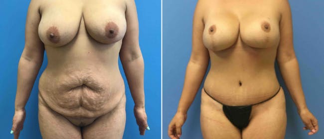 Breast Augmentation Before & After Gallery - Patient 38566405 - Image 1