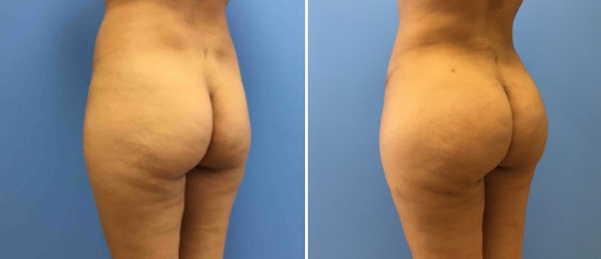 Brazilian Butt Lift Before & After Gallery - Patient 38566408 - Image 1