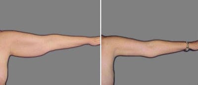 Brachioplasty (Upper Arm Lift) Before & After Gallery - Patient 38566406 - Image 1