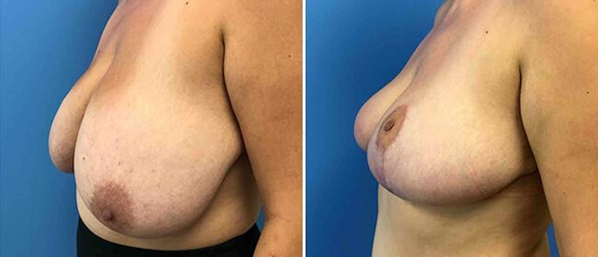 Breast Reduction Before & After Gallery - Patient 38566409 - Image 1
