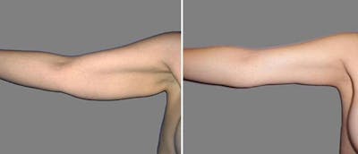Brachioplasty (Upper Arm Lift) Before & After Gallery - Patient 38566410 - Image 1