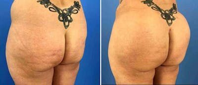 Brazilian Butt Lift Before & After Gallery - Patient 38566412 - Image 1