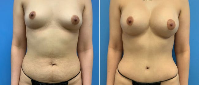 Mommy Makeover Before & After Gallery - Patient 41697363 - Image 1