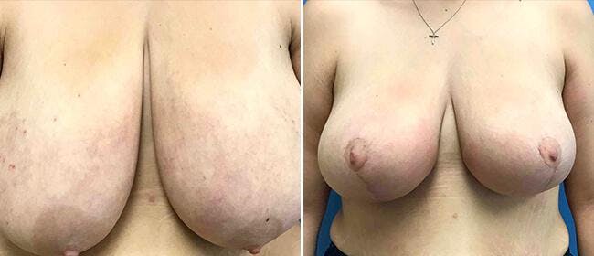 Breast Reduction Before & After Gallery - Patient 38566414 - Image 1
