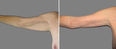 Brachioplasty (Upper Arm Lift) Before & After Gallery - Patient 38566415 - Image 1