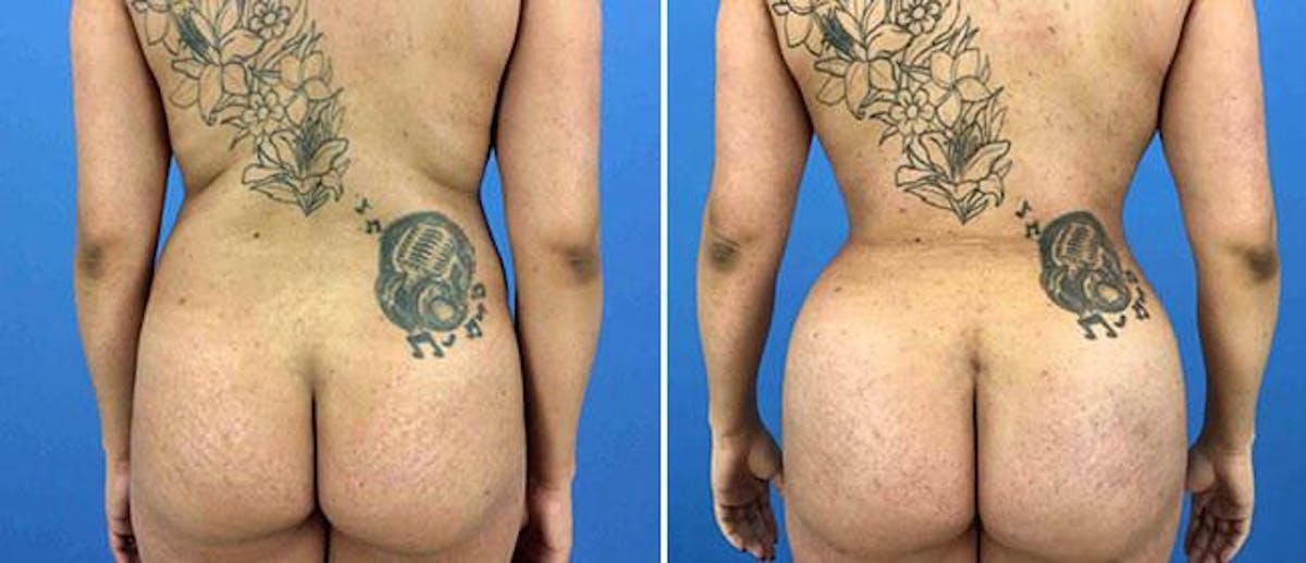 Butt Augmentation Before & After Gallery - Patient 38566418 - Image 1
