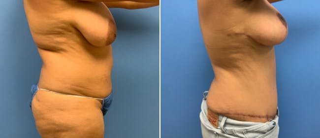 Abdominoplasty (Tummy Tuck) Before & After Gallery - Patient 38566420 - Image 2