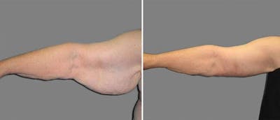 Brachioplasty (Upper Arm Lift) Before & After Gallery - Patient 38566421 - Image 1