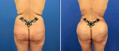 Brazilian Butt Lift Before & After Gallery - Patient 38566422 - Image 1