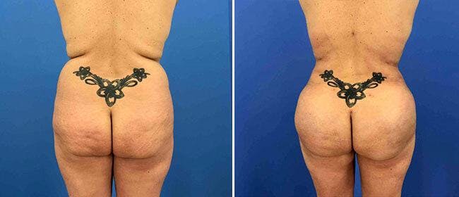 Brazilian Butt Lift Before & After Gallery - Patient 38566422 - Image 1