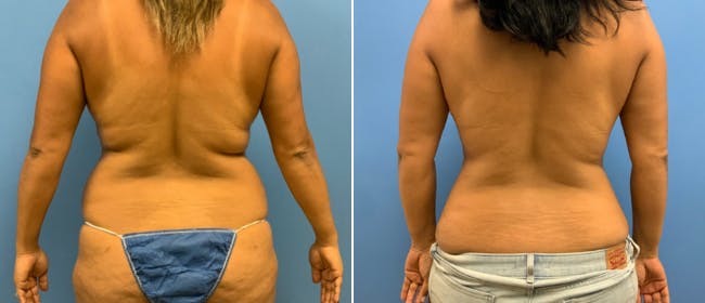 Abdominoplasty (Tummy Tuck) Before & After Gallery - Patient 38566420 - Image 3