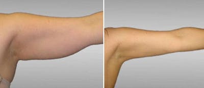 Brachioplasty (Upper Arm Lift) Before & After Gallery - Patient 38566424 - Image 1
