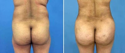 Brazilian Butt Lift Before & After Gallery - Patient 38566426 - Image 1