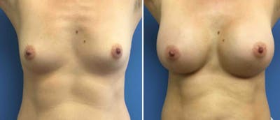 Breast Augmentation Before & After Gallery - Patient 38566427 - Image 1