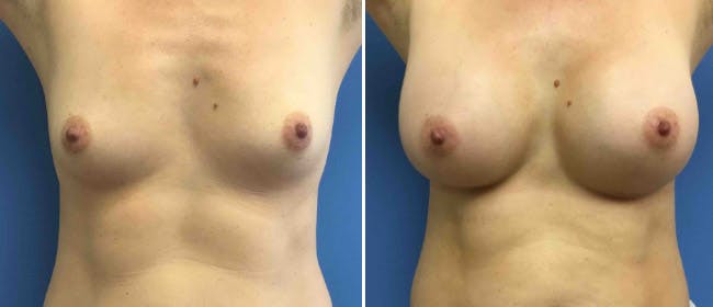 Breast Augmentation Before & After Gallery - Patient 38566427 - Image 1