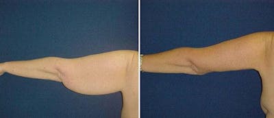 Arm Lift Before & After Gallery - Patient 38566428 - Image 1
