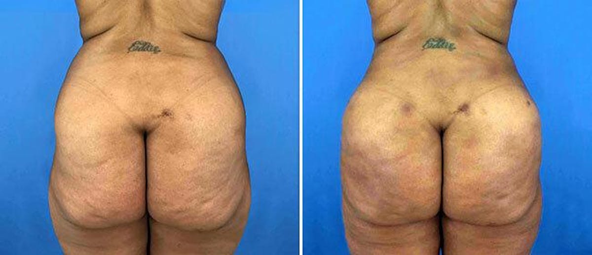 Butt Augmentation Before & After Gallery - Patient 38566429 - Image 1