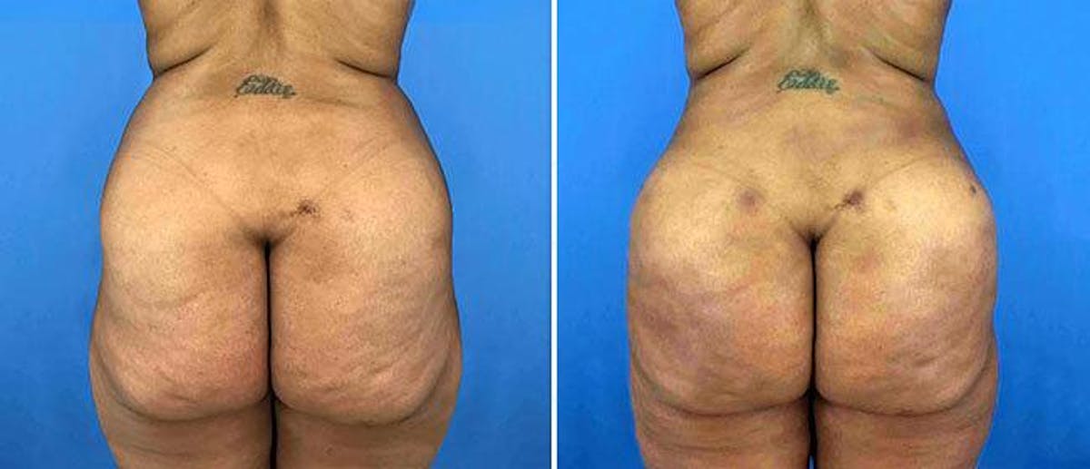 Brazilian Butt Lift Before & After Gallery - Patient 38566429 - Image 1