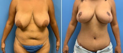 Mommy Makeover Before & After Gallery - Patient 41697364 - Image 1