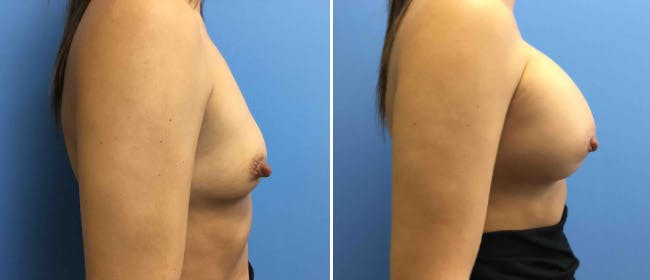 Breast Augmentation Before & After Gallery - Patient 38566431 - Image 1