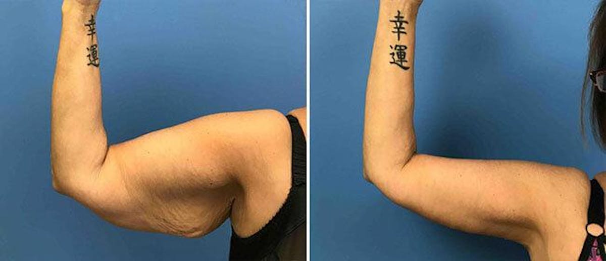 Brachioplasty (Upper Arm Lift) Before & After Gallery - Patient 38566432 - Image 1