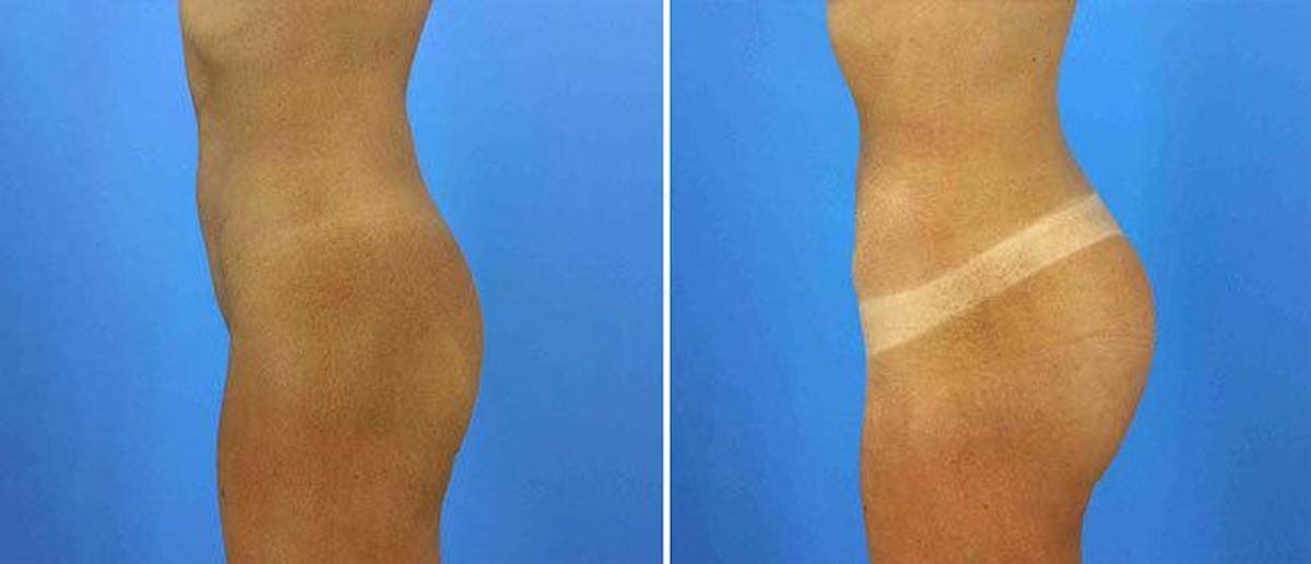Buttocks Enlargement (Implants) Before & After Gallery - Patient 38566433 - Image 1
