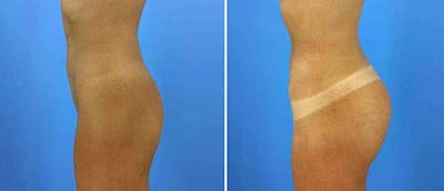 Buttocks Enlargement (Implants) Before & After Gallery - Patient 38566433 - Image 1