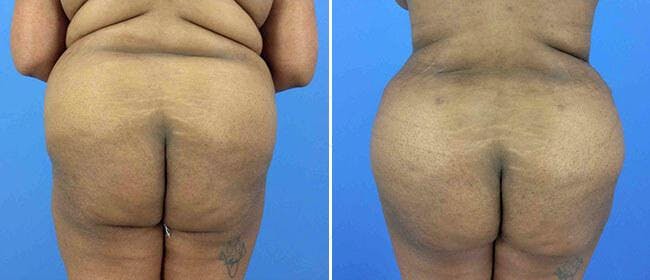 Brazilian Butt Lift Before & After Gallery - Patient 38566434 - Image 1