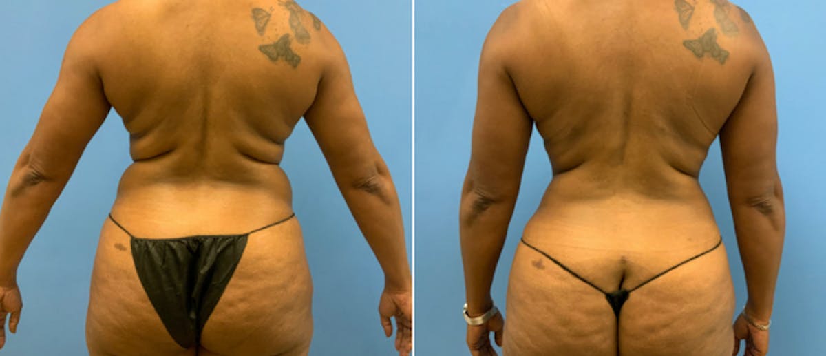 Tummy Tuck Before & After Gallery - Patient 38566436 - Image 2