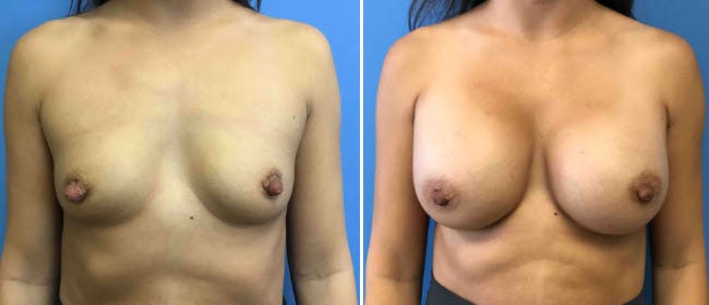 Breast Augmentation Before & After Gallery - Patient 38566431 - Image 2