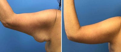 Arm Lift Before & After Gallery - Patient 38566437 - Image 1