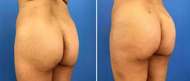 Brazilian Butt Lift Before & After Gallery - Patient 38566439 - Image 1
