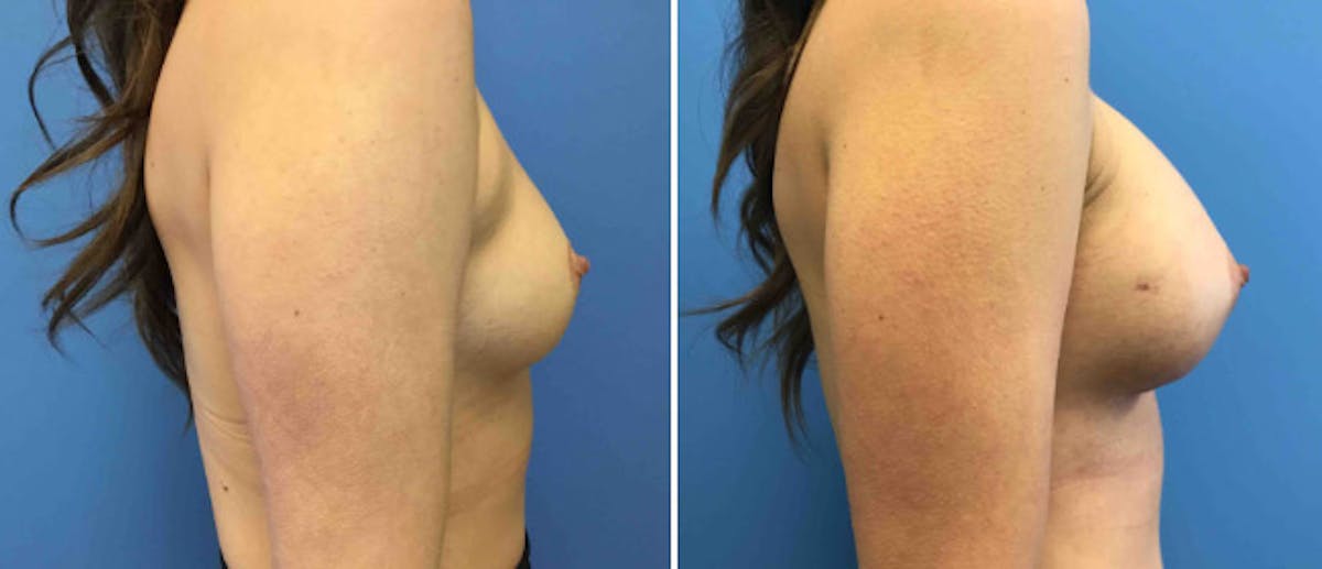 Breast Augmentation Before & After Gallery - Patient 38566440 - Image 2