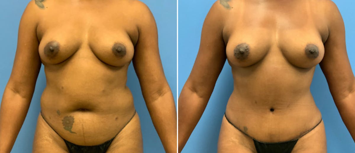 Tummy Tuck Before & After Gallery - Patient 38566436 - Image 1