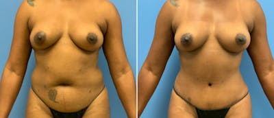 Tummy Tuck Before & After Gallery - Patient 38566436 - Image 1