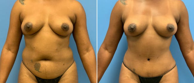 Abdominoplasty (Tummy Tuck) Before & After Gallery - Patient 38566436 - Image 1