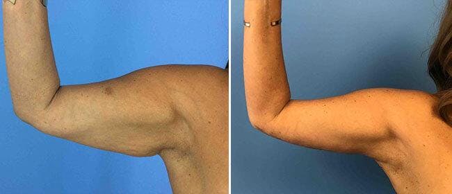 Brachioplasty (Upper Arm Lift) Before & After Gallery - Patient 38566441 - Image 1