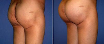 Buttocks Enlargement (Implants) Before & After Gallery - Patient 38566443 - Image 1