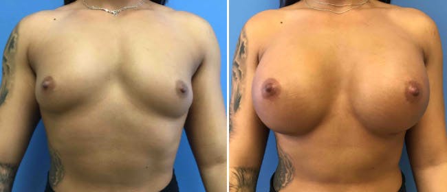 Breast Augmentation Before & After Gallery - Patient 38566440 - Image 1