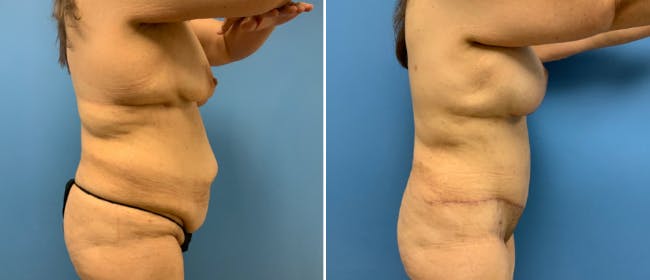 Abdominoplasty (Tummy Tuck) Before & After Gallery - Patient 38566450 - Image 2