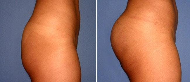 Buttocks Enlargement (Implants) Before & After Gallery - Patient 38566449 - Image 1