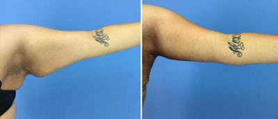 Arm Lift Before & After Gallery - Patient 38566452 - Image 1