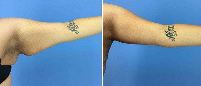 Brachioplasty (Upper Arm Lift) Before & After Gallery - Patient 38566452 - Image 1