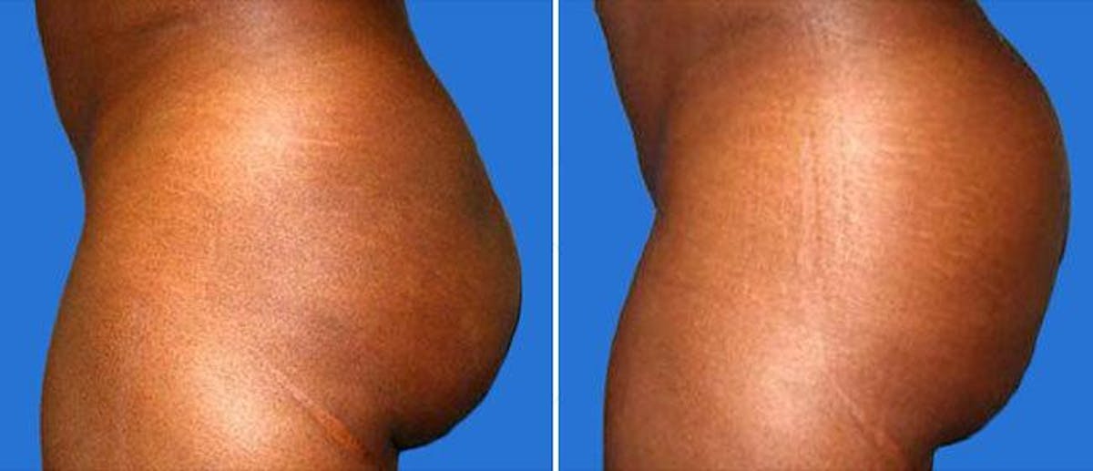Buttocks Enlargement (Implants) Before & After Gallery - Patient 38566454 - Image 1