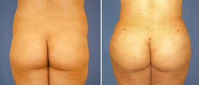 Brazilian Butt Lift Before & After Gallery - Patient 38566458 - Image 1
