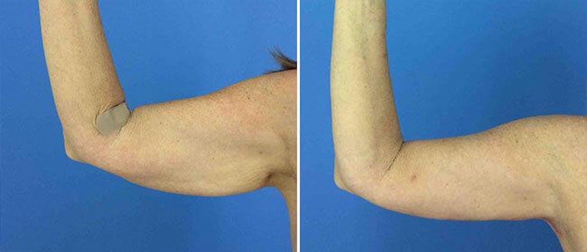 Brachioplasty (Upper Arm Lift) Before & After Gallery - Patient 38566457 - Image 1