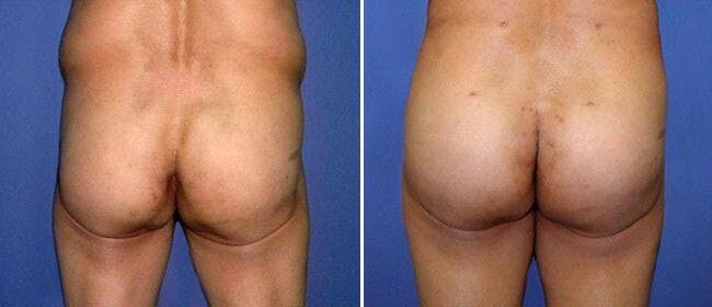 Buttocks Enlargement (Implants) Before & After Gallery - Patient 38566459 - Image 1