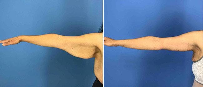 Brachioplasty (Upper Arm Lift) Before & After Gallery - Patient 38566473 - Image 1